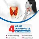 Symptoms of Thyroid Cancer